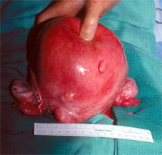 Large fibroid uterus