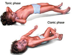 clonic phase