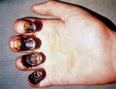 Bubonic-Plague in finger