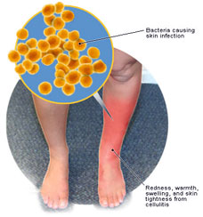 Skin Cellulitis images