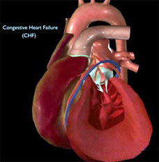Congestive Heart Failure Develops