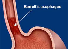 barretts esophagus