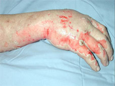 Diseases in skin
