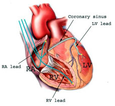 Biventricular Pacemaker Leads