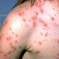 chikenpox skin