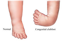 clubfoot images