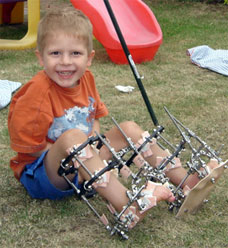 Child Wearing a Distraction Frame