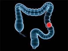 Colon Cancer in Diseases