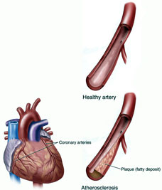 Plaque Buildup in Arteries