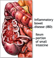 Ileum portion of samll intestine