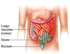 Crohn's disease recurrence