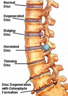 osteophyte formation