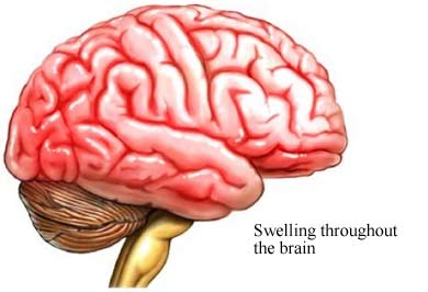 Encephalitis