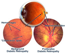 background diabetic retinopathy