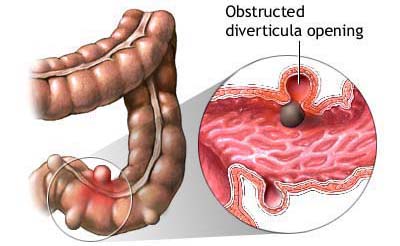 diverticulosis images