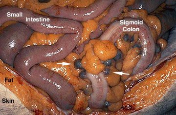 Diverticulosis Seen at Autopsy