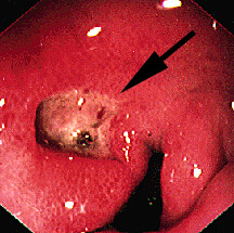 duodenalulcer images
