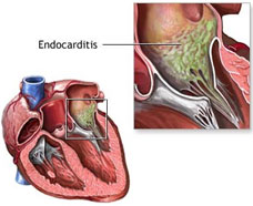 Endocarditis in pharma