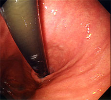 Stomach Endoscopy