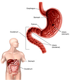 Stomach and Duodenal Ulcers