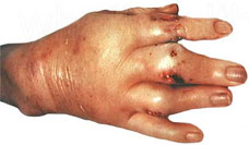 Gout Affected Hand