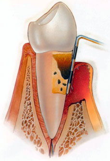 called periodontitis