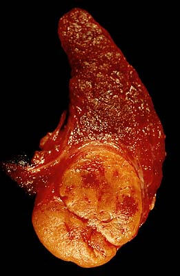 Follicular adenoma of the Thyroid