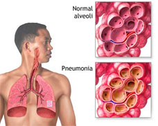 Pharmaceuticals Pneumonia Protein