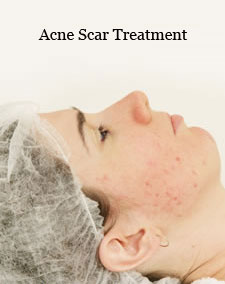 acne scar treatment