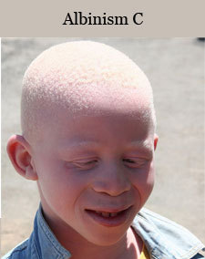 albinism c