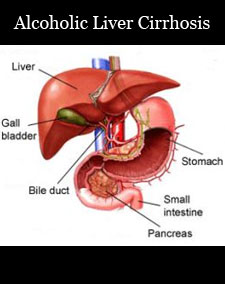 alcoholic liver cirrhosis