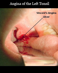 angina of the tonsil