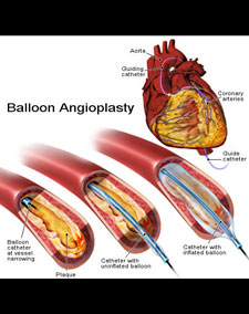 balloon angioplasty