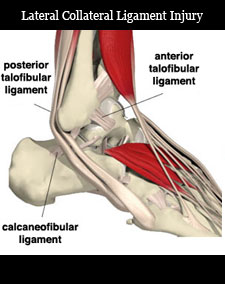 lateral collateral ligament injury