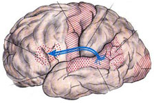 Apraxia