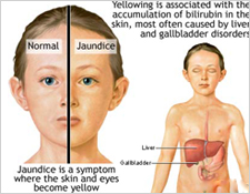 Jaundice Symptoms