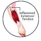 inflammed extensor tendon