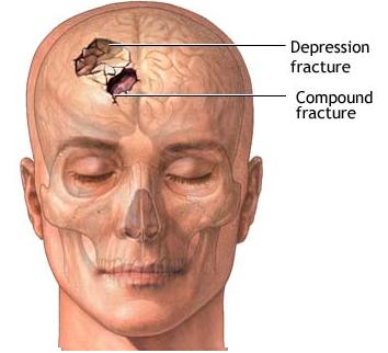 Skull fracture