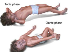 tonic-clonic-seizures