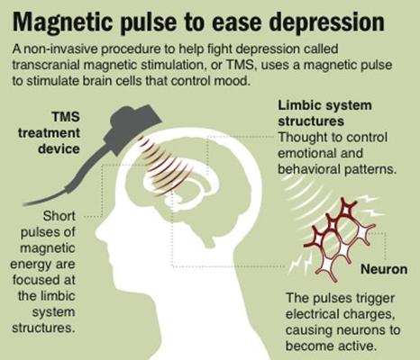 magnetic pulse