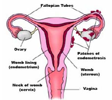 Endometriosis affects women