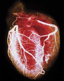 Coronary Artery Angiography