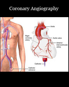 coronary angiography